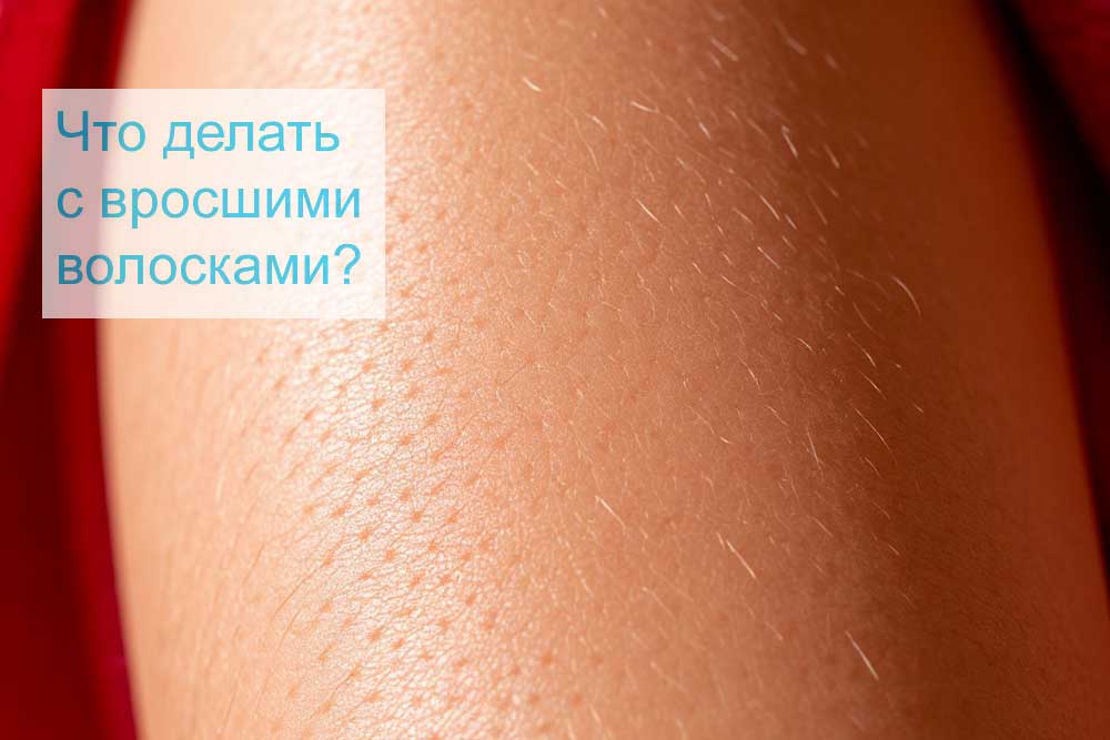 Что делать с вросшими волосками?